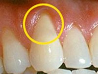periodontal_13